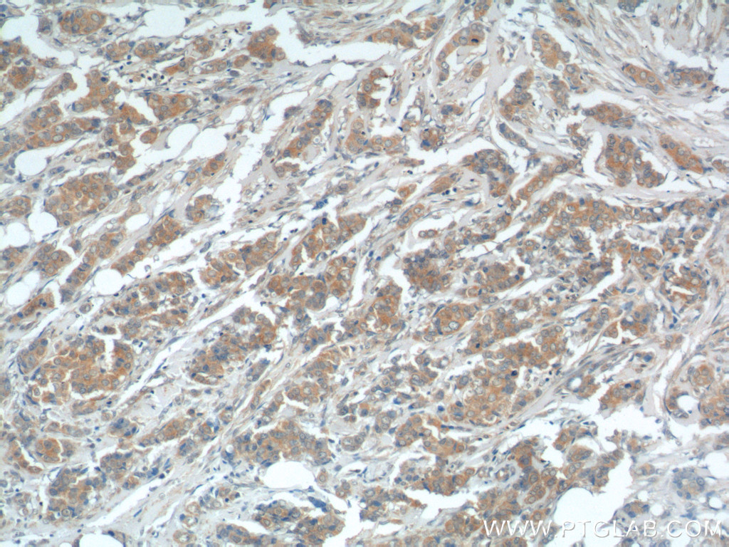 IHC staining of human breast cancer using 14354-1-AP