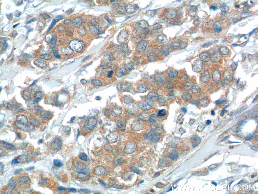 IHC staining of human breast cancer using 14354-1-AP