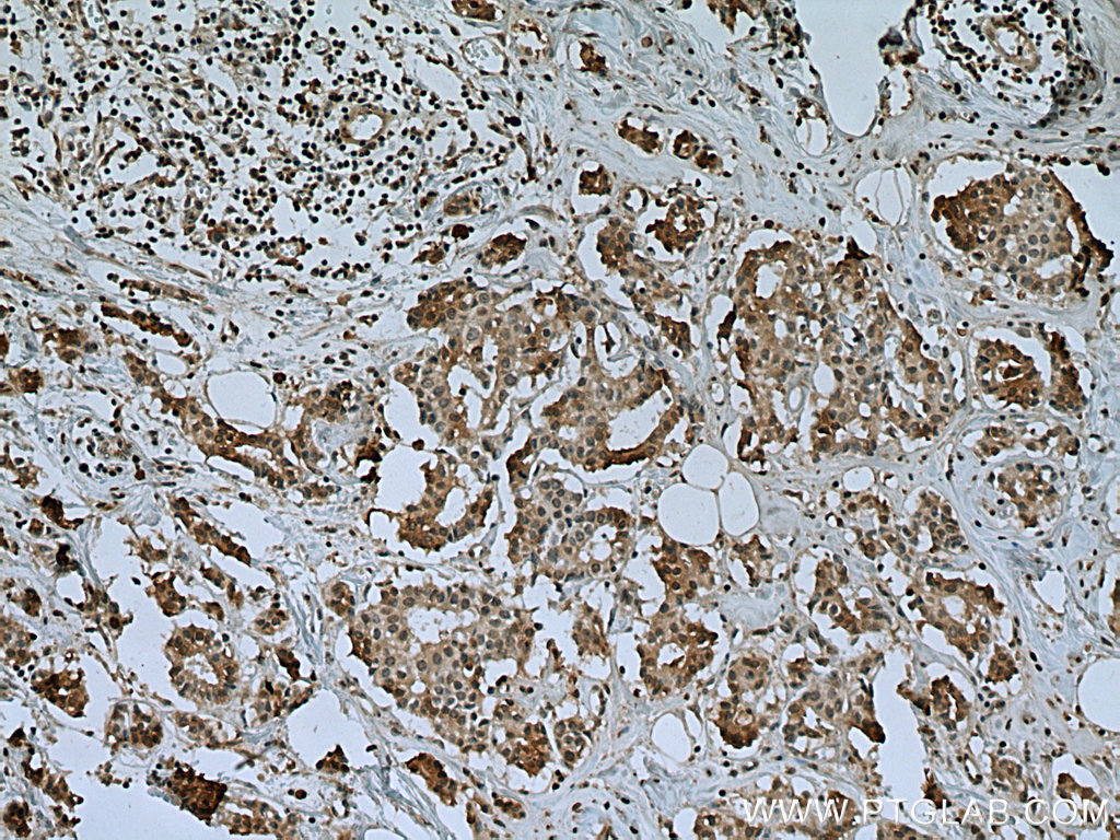 IHC staining of human breast cancer using 67557-1-Ig (same clone as 67557-1-PBS)
