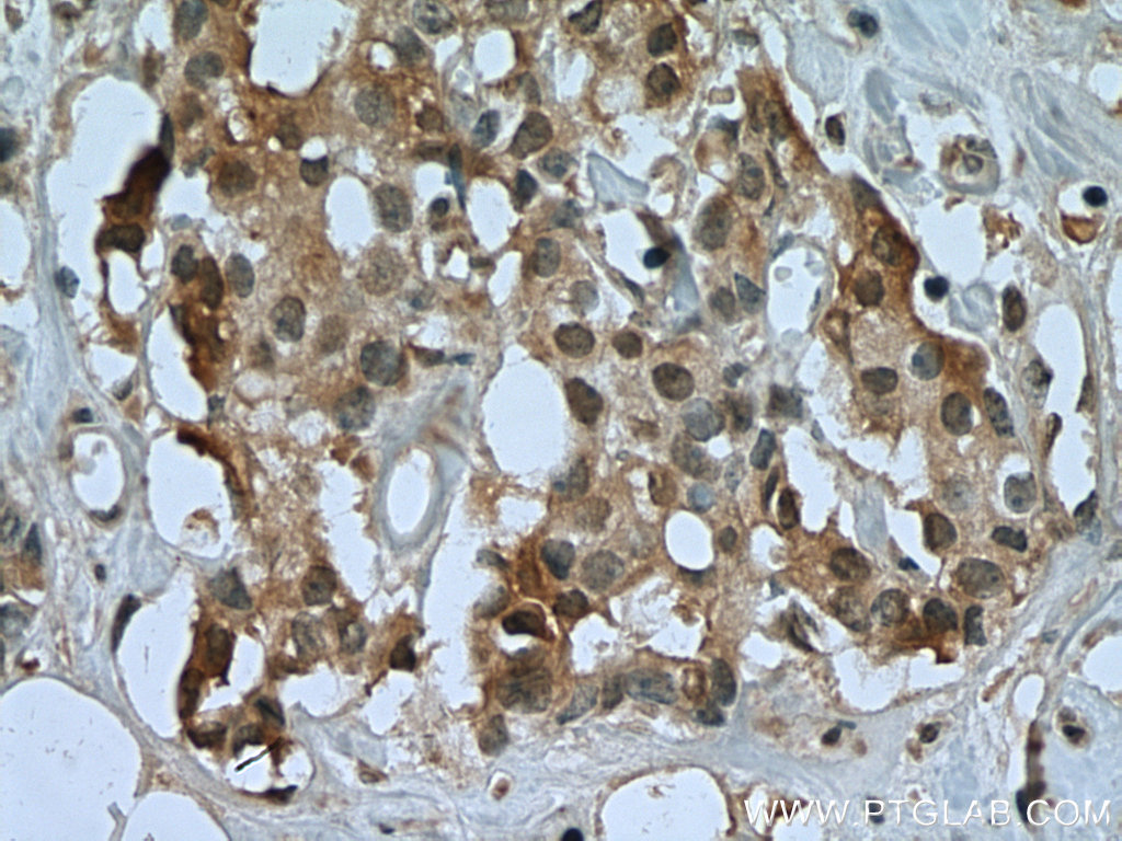 IHC staining of human breast cancer using 67557-1-Ig (same clone as 67557-1-PBS)