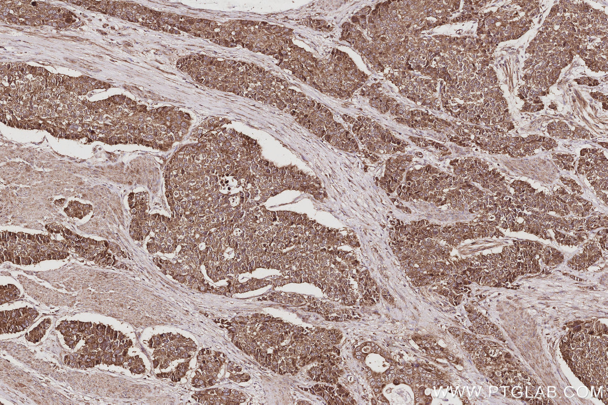 IHC staining of human stomach cancer using 17491-1-AP IHC staining of human stomach cancer using 17491-1-AP