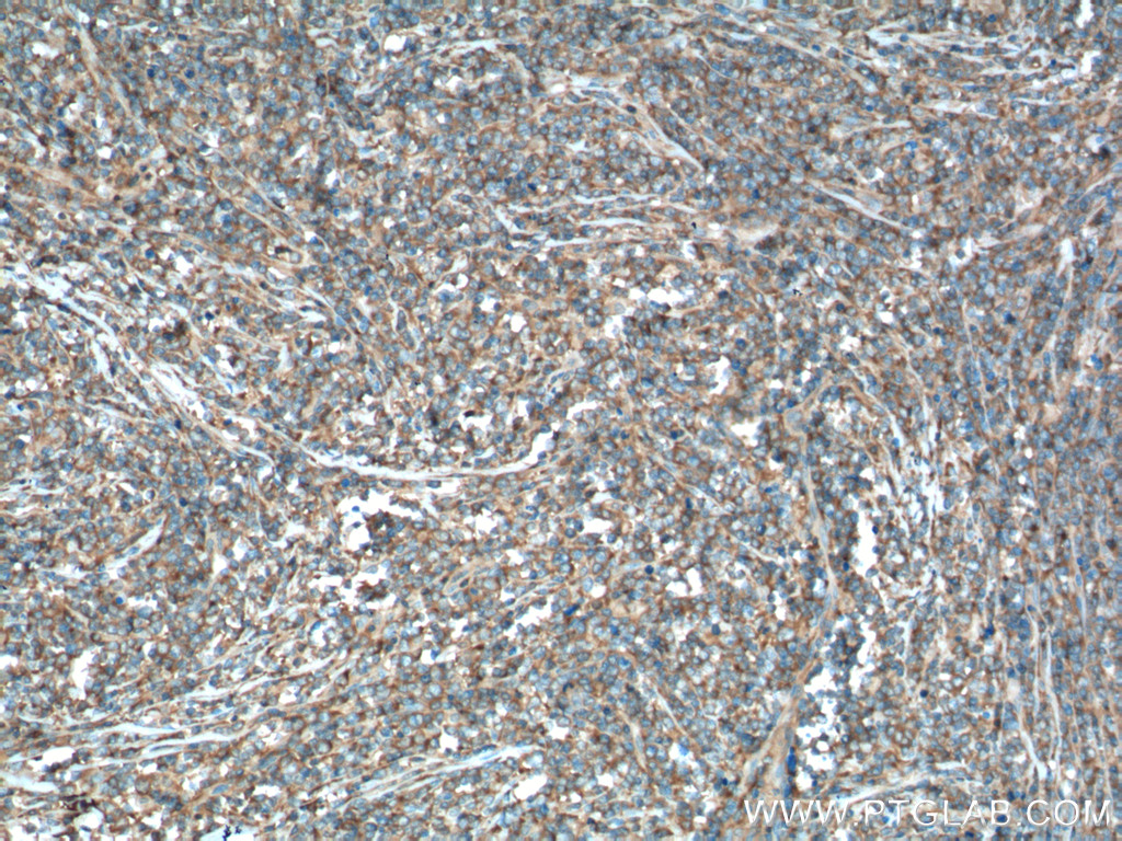 IHC staining of human lymphoma using 13126-1-AP