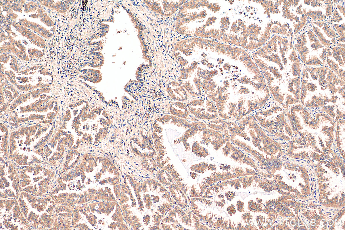 IHC staining of human lung cancer using 12199-1-AP (same clone as 12199-1-PBS)