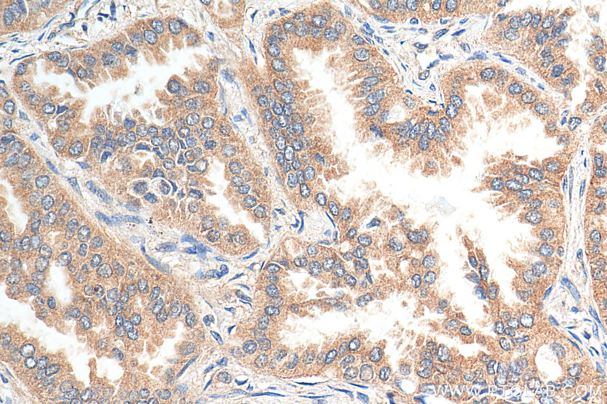 IHC staining of human lung cancer using 12199-1-AP (same clone as 12199-1-PBS)