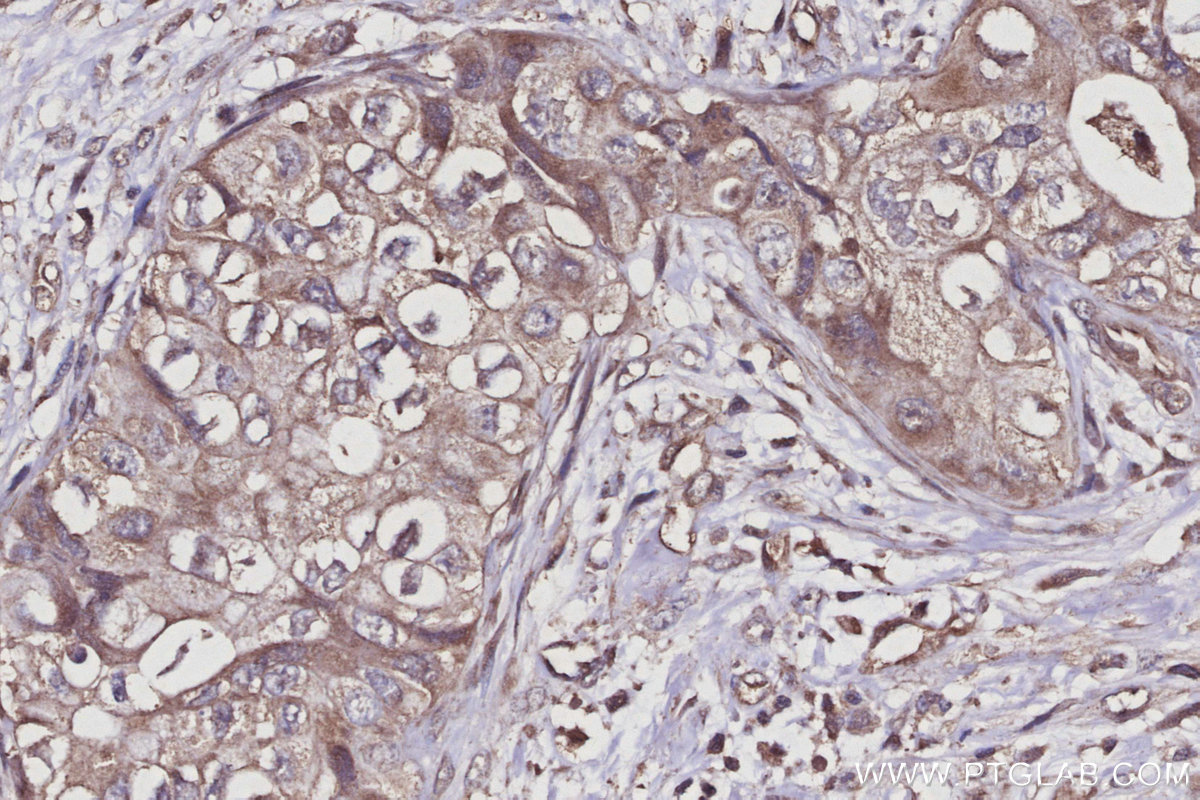 IHC staining of human pancreas cancer using 27522-1-AP
