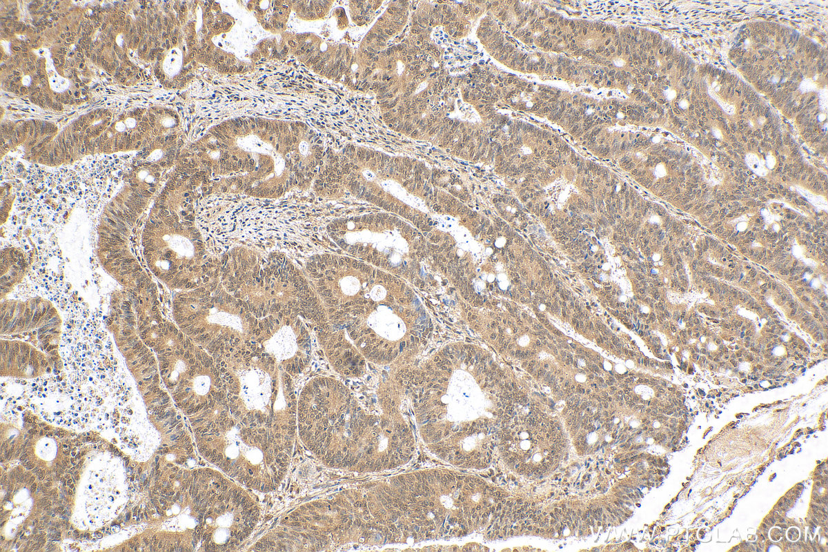 IHC staining of human colon cancer using 24559-1-AP