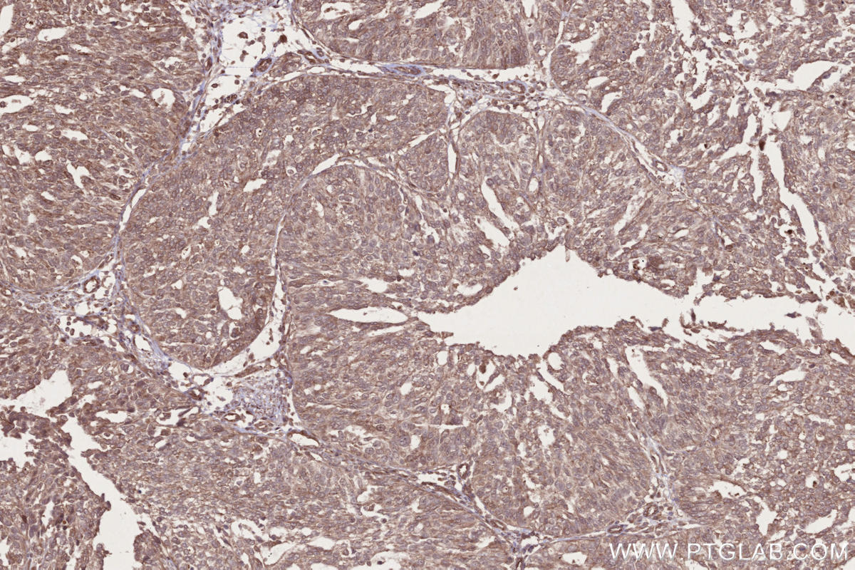 IHC staining of human ovary cancer using 17767-1-AP IHC staining of human ovary cancer using 17767-1-AP