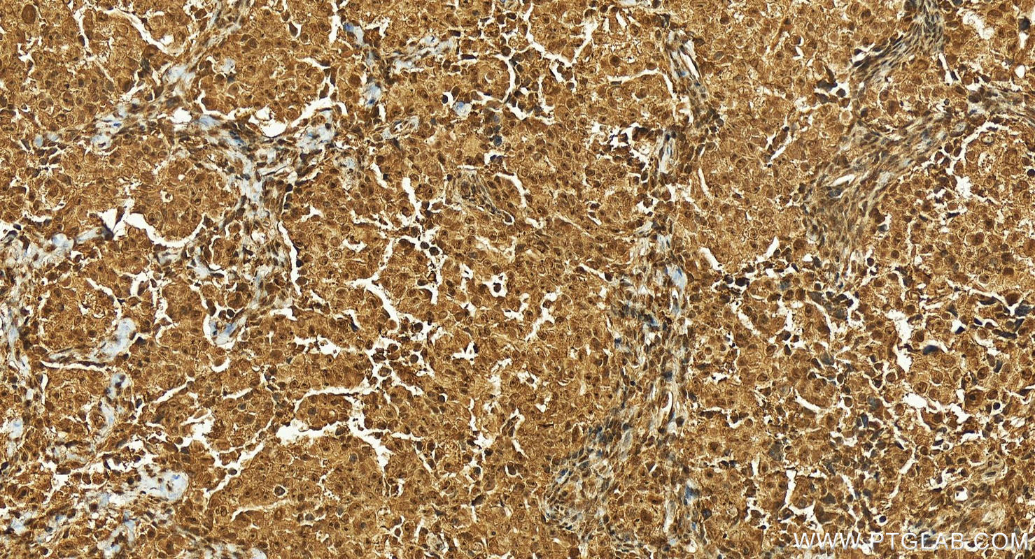 IHC staining of human ovary cancer using 24976-1-AP