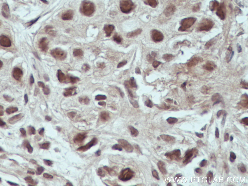 IHC staining of human breast cancer using 66822-1-Ig