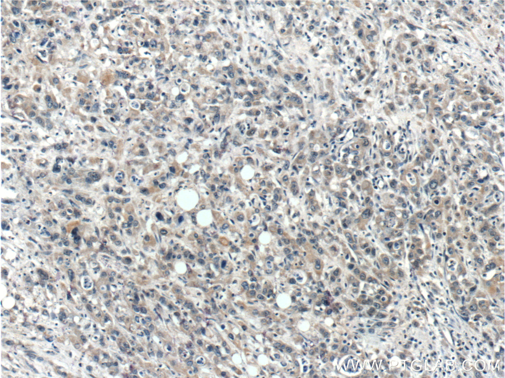 IHC staining of human stomach cancer using 15866-1-AP