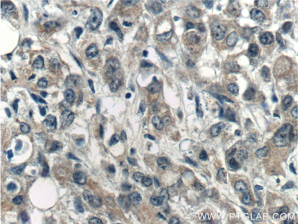 IHC staining of human stomach cancer using 15866-1-AP