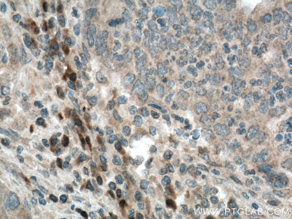 IHC staining of human colon cancer using 18066-1-AP