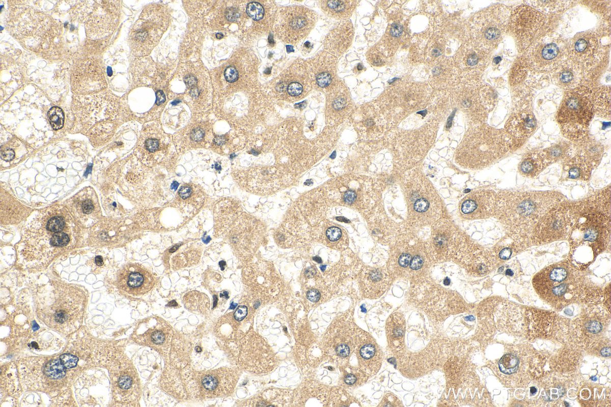 IHC staining of human hepatocirrhosis using 24817-1-AP