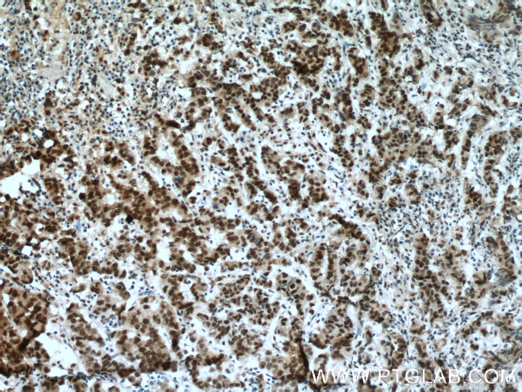 IHC staining of human prostate cancer using 26948-1-AP