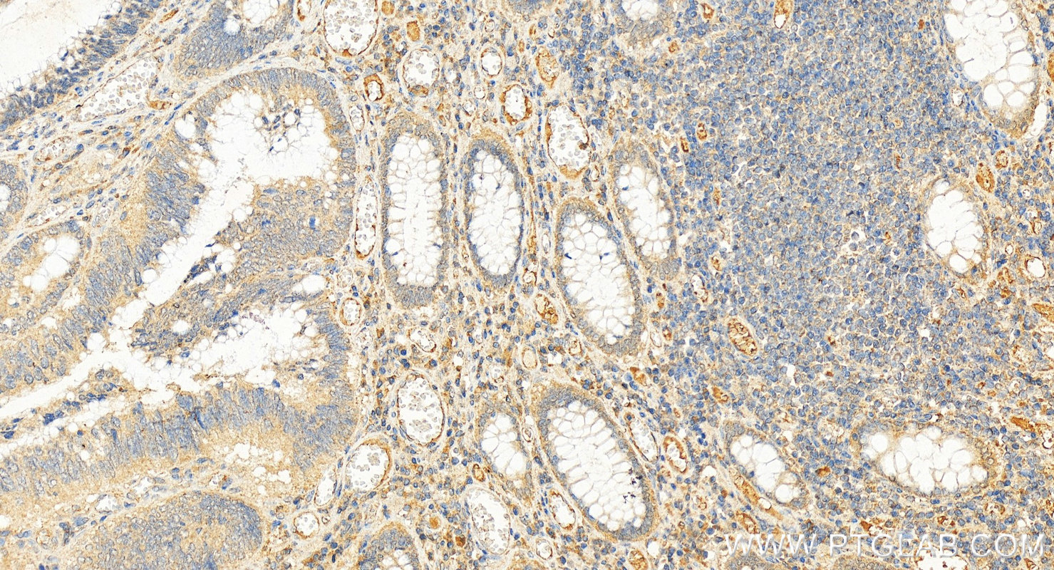 IHC staining of human colon cancer using 27578-1-AP