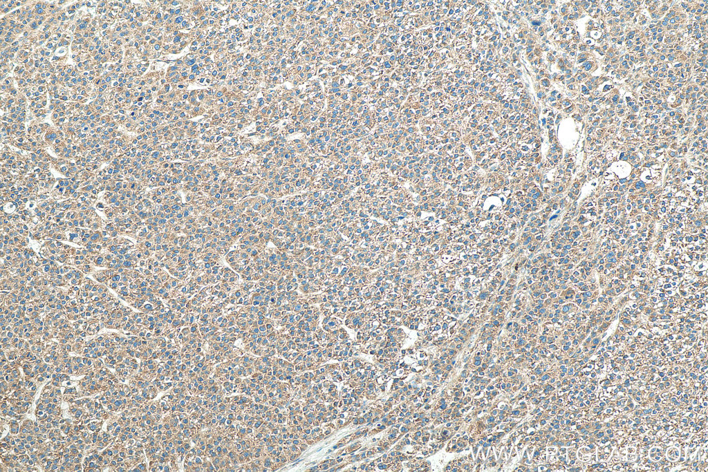 IHC staining of human liver cancer using 67845-1-Ig