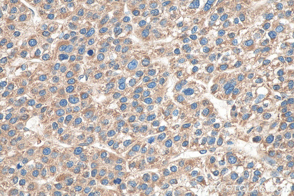IHC staining of human liver cancer using 67845-1-Ig (same clone as 67845-1-PBS)