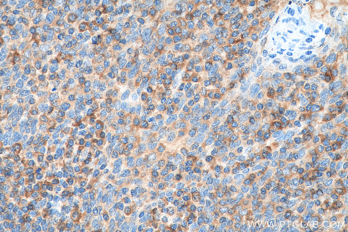IHC staining of human tonsillitis using 15931-1-AP