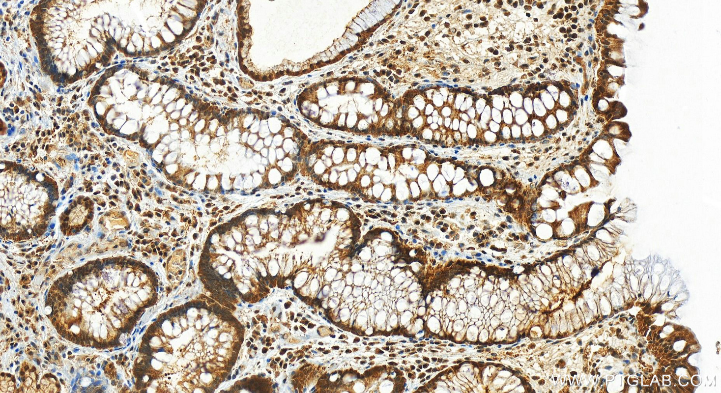 IHC staining of human stomach cancer using 13303-1-AP