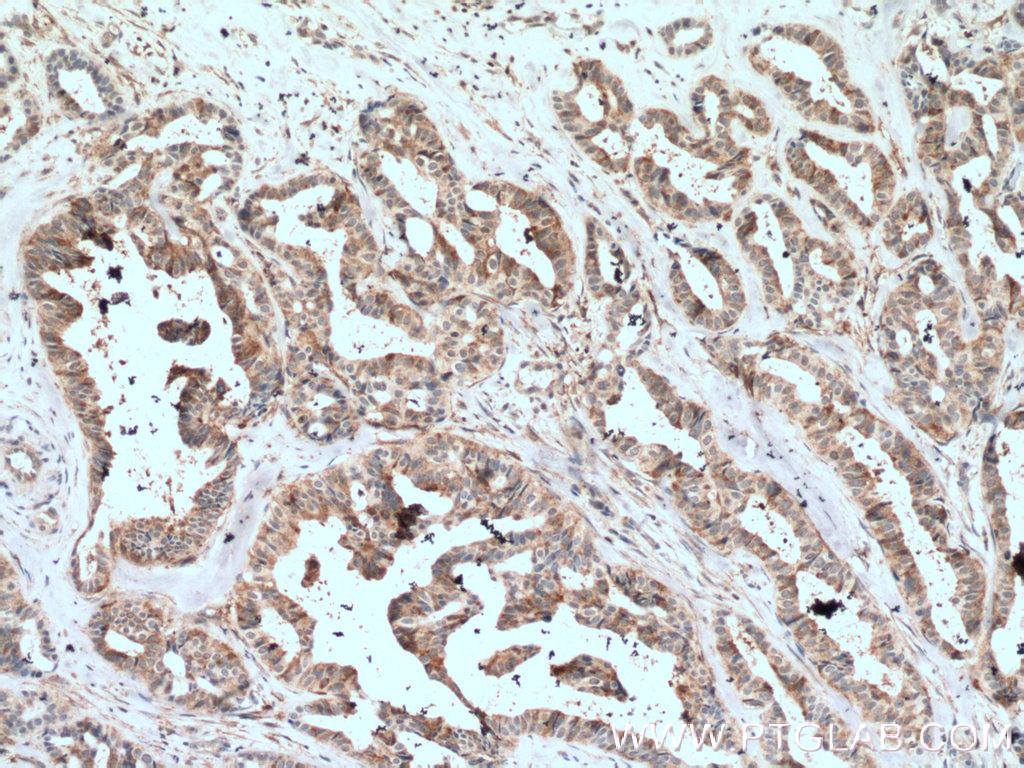 IHC staining of human breast cancer using 16364-1-AP