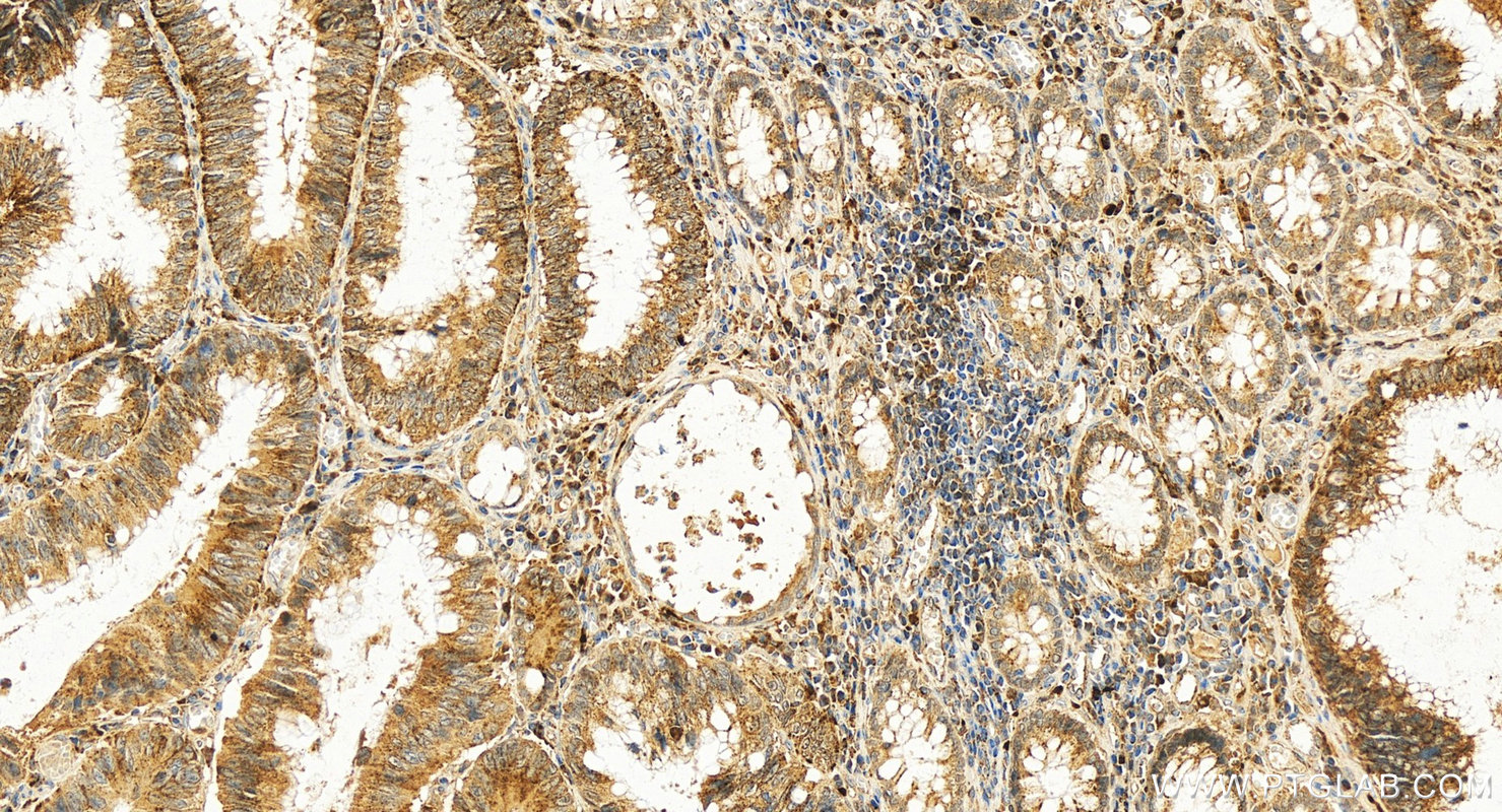 IHC staining of human colon cancer using 30291-1-AP