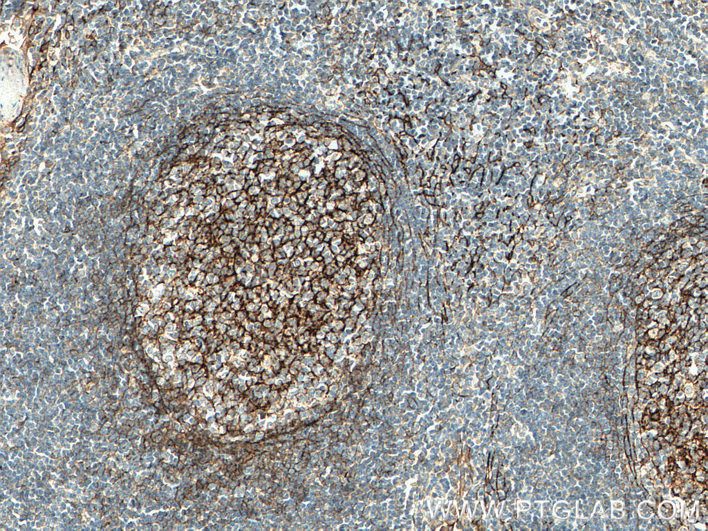 IHC staining of human tonsillitis using 11444-1-AP