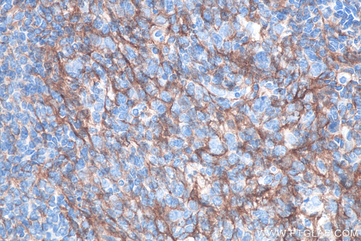 IHC staining of human tonsillitis using 66294-1-Ig