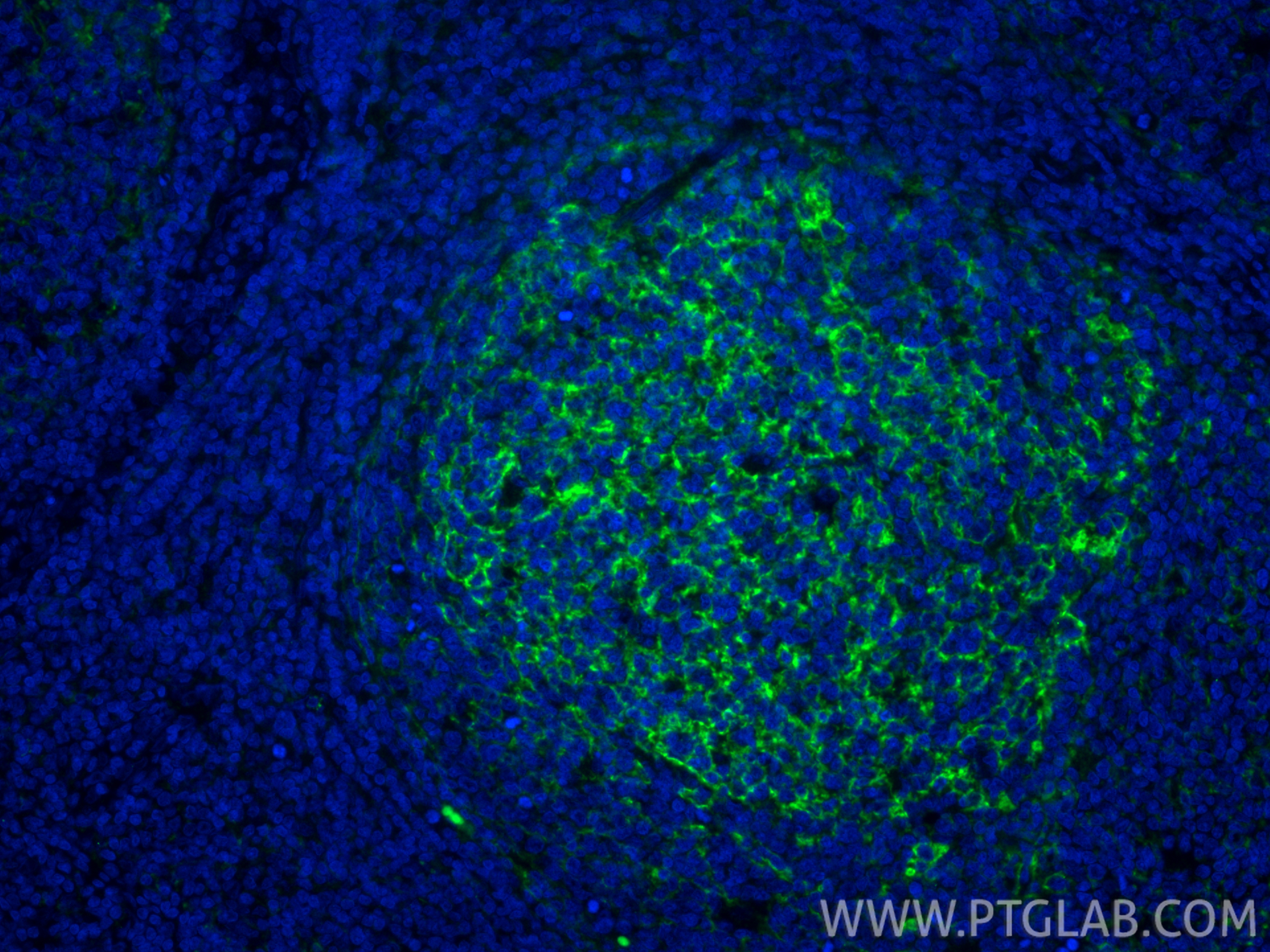 IF Staining of human tonsillitis using 84249-4-RR IF Staining of human tonsillitis using 84249-4-RR