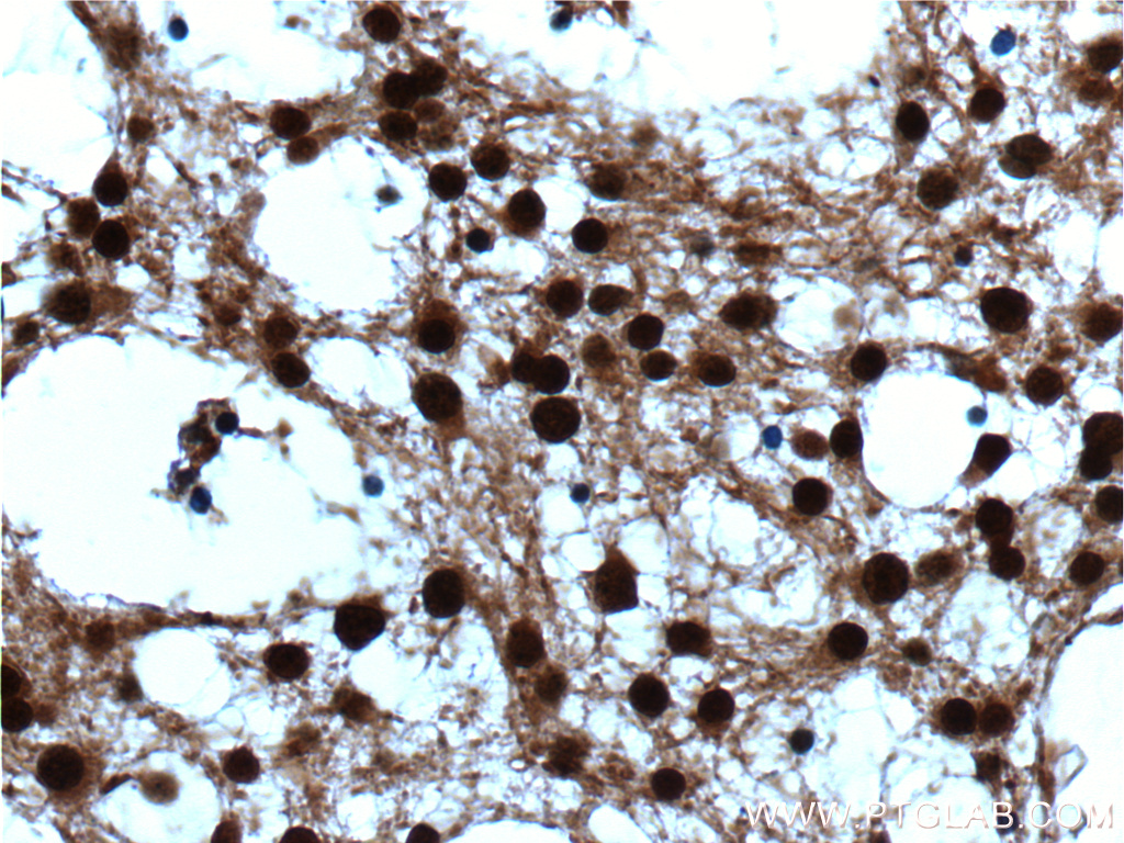 IHC staining of human gliomas using 10736-1-AP