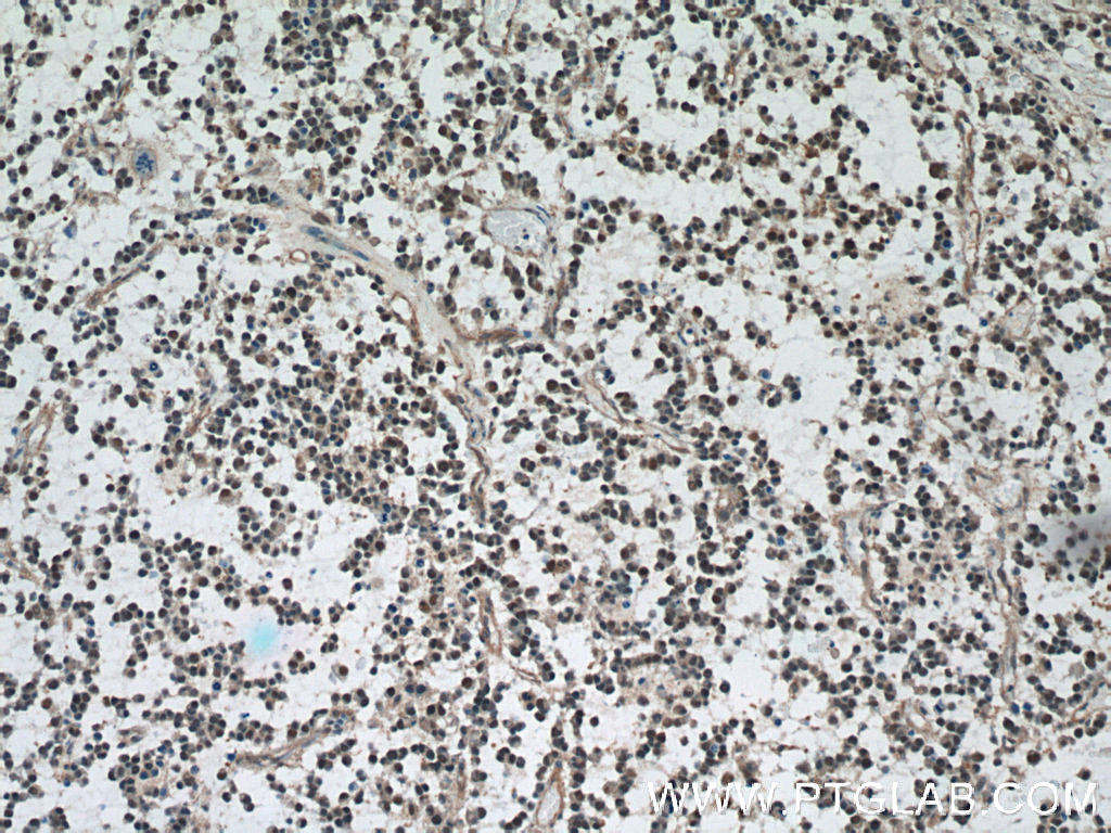 IHC staining of human gliomas using 60316-1-Ig