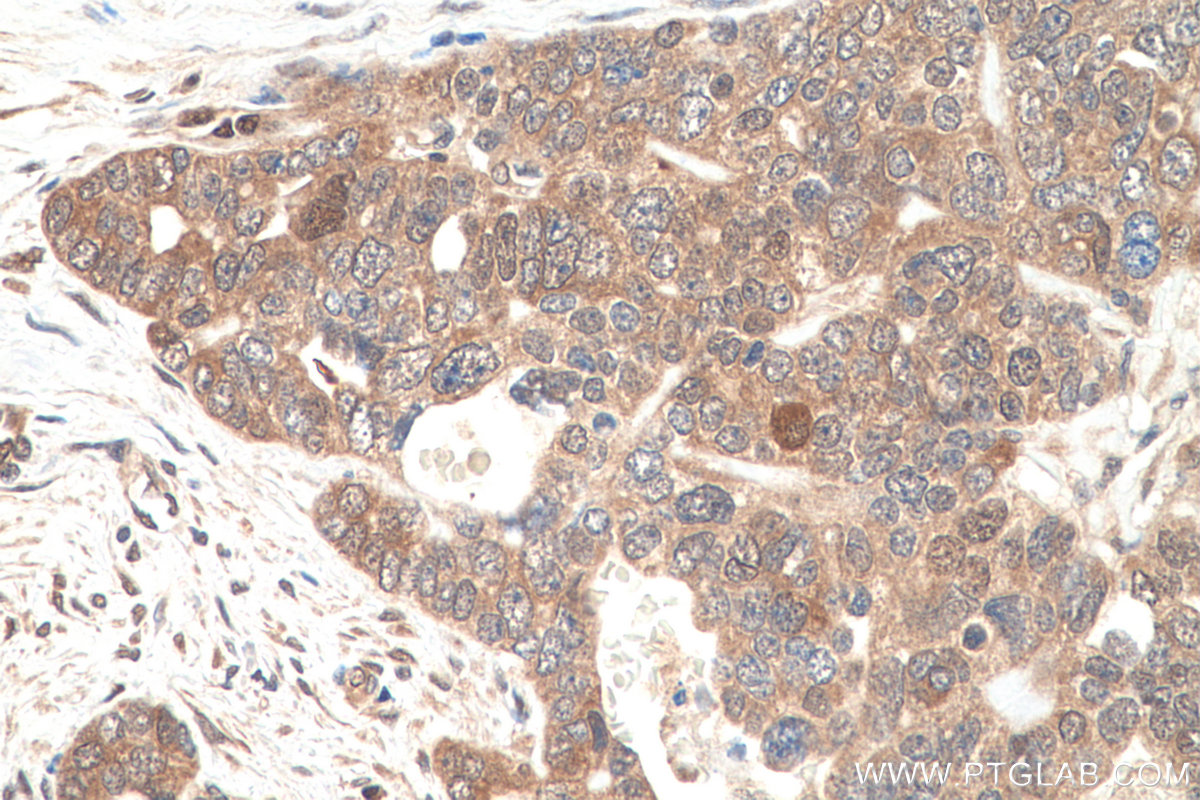 IHC staining of human ovary tumor using 60316-1-Ig