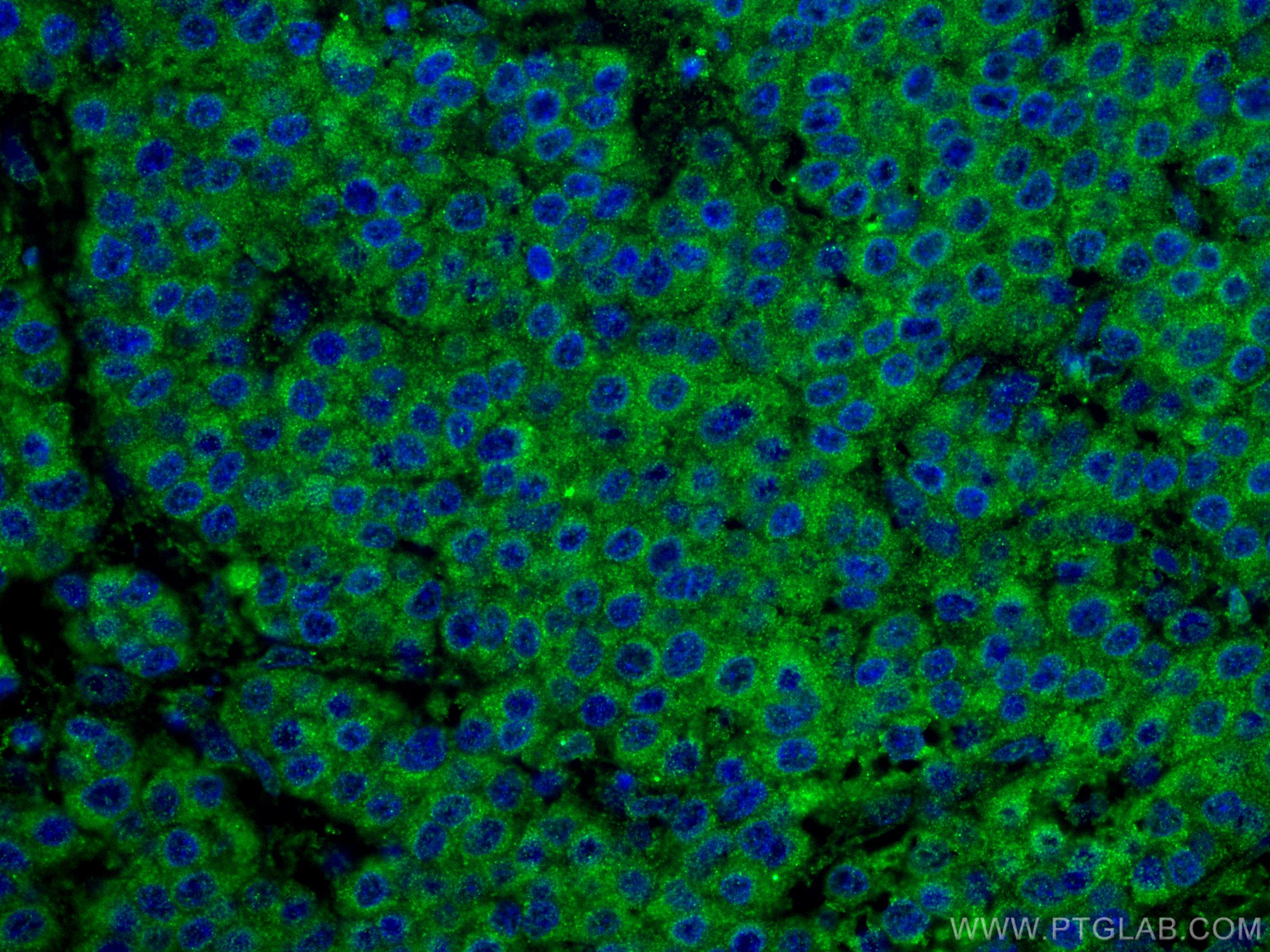 IF Staining of human liver cancer using 55259-1-AP