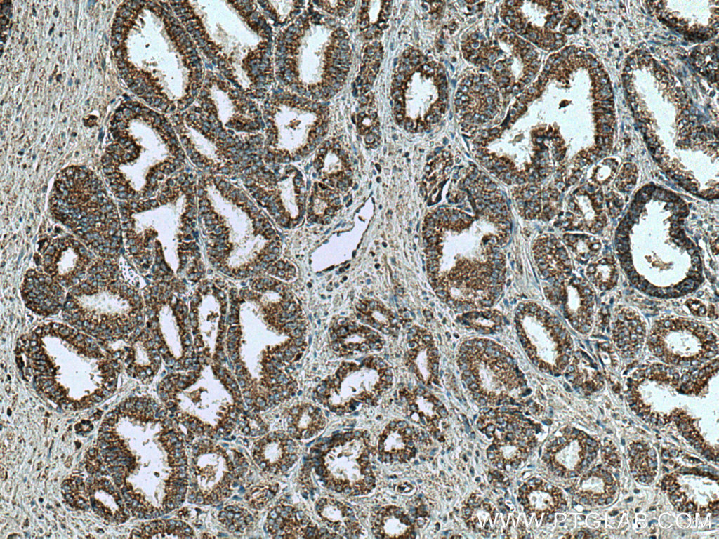 IHC staining of human prostate cancer using 11663-1-AP