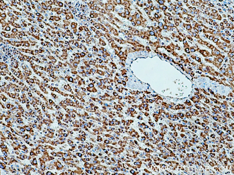 IHC staining of human liver cancer using 14451-1-AP
