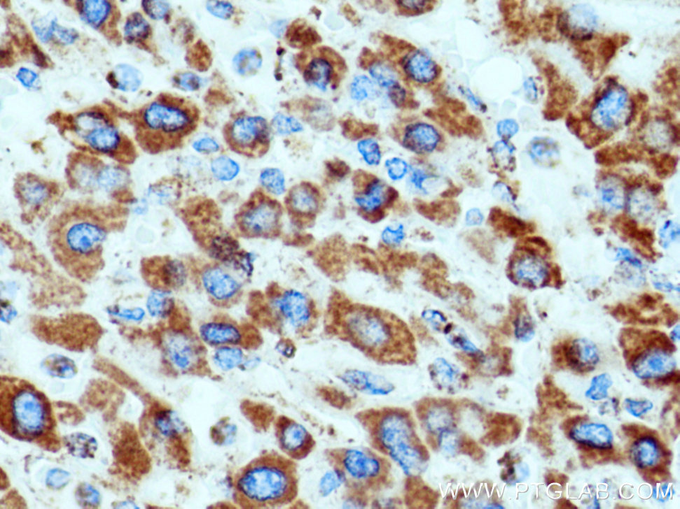 IHC staining of human liver cancer using 14451-1-AP