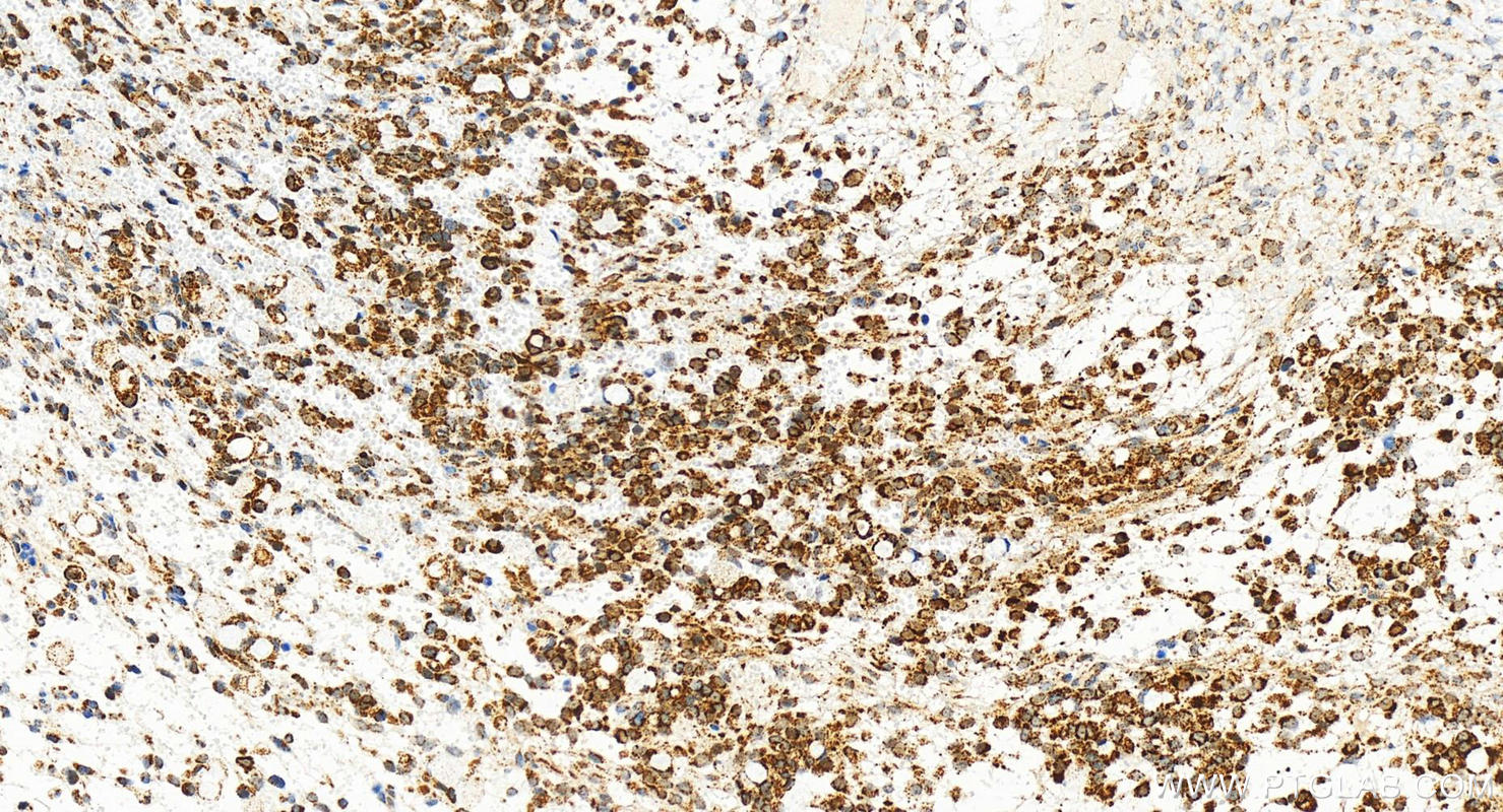 IHC staining of human ovary cancer using 82666-14-RR