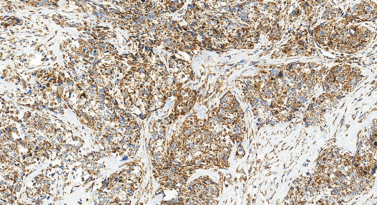 Immunohistochemical analysis of paraffin-embedded human ovary cancer tissue slide using RMX00001 (VDAC3 antibody) at dilution of 1:1000 (under 20x lens). Heat mediated antigen retrieval with Tris-EDTA buffer (pH 9.0). IHC staining of human ovary cancer using RMX00001