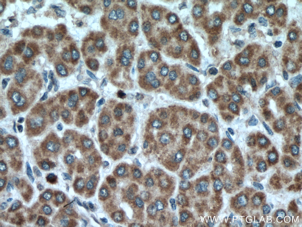 IHC staining of human liver cancer using 26381-1-AP