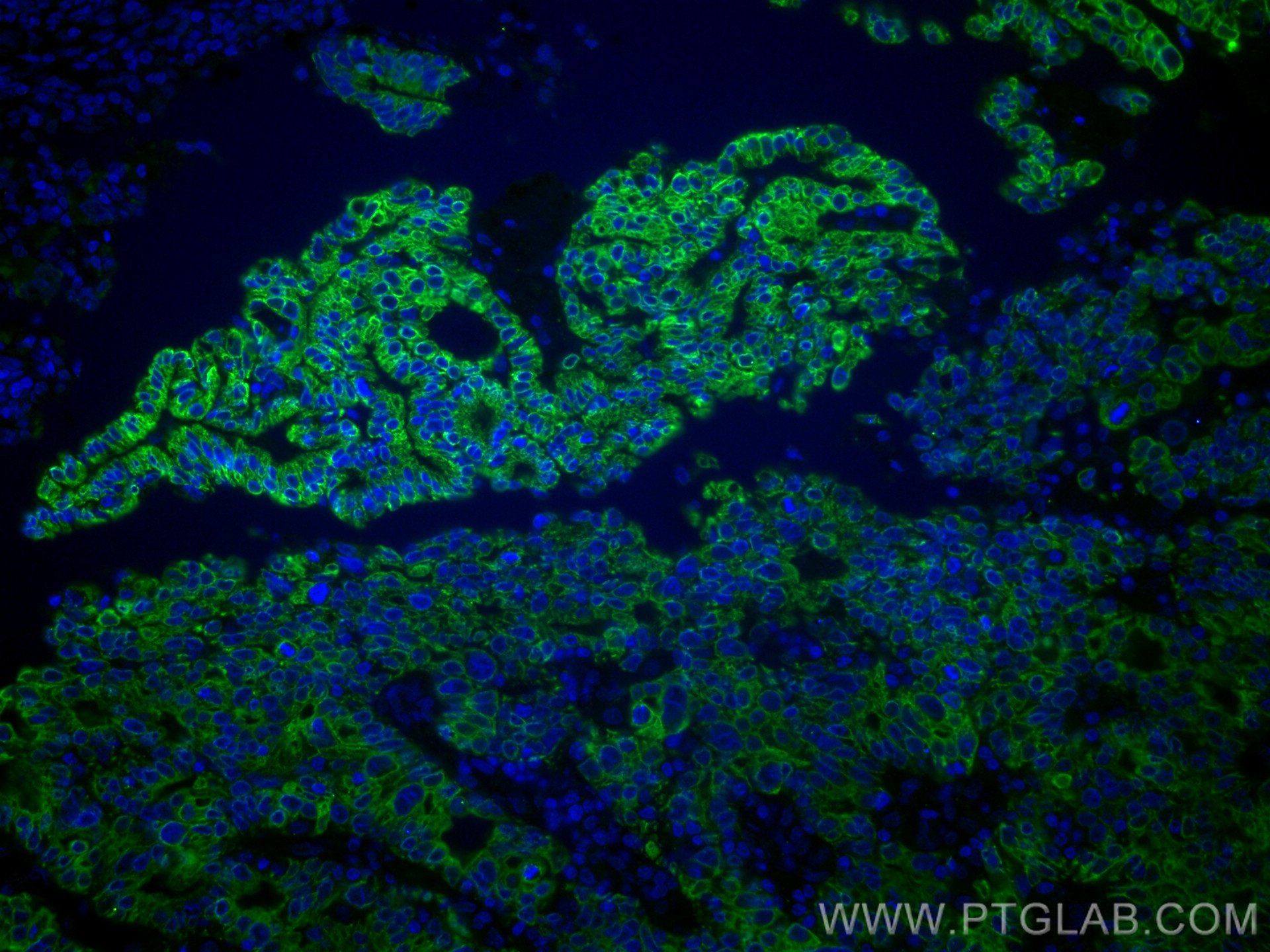 IF Staining of human endometrial cancer using 66828-1-Ig (same clone as 66828-1-PBS)