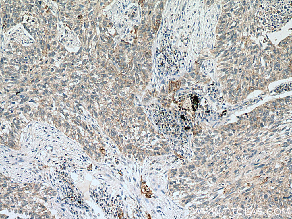 IHC staining of human lung cancer using 66828-1-Ig