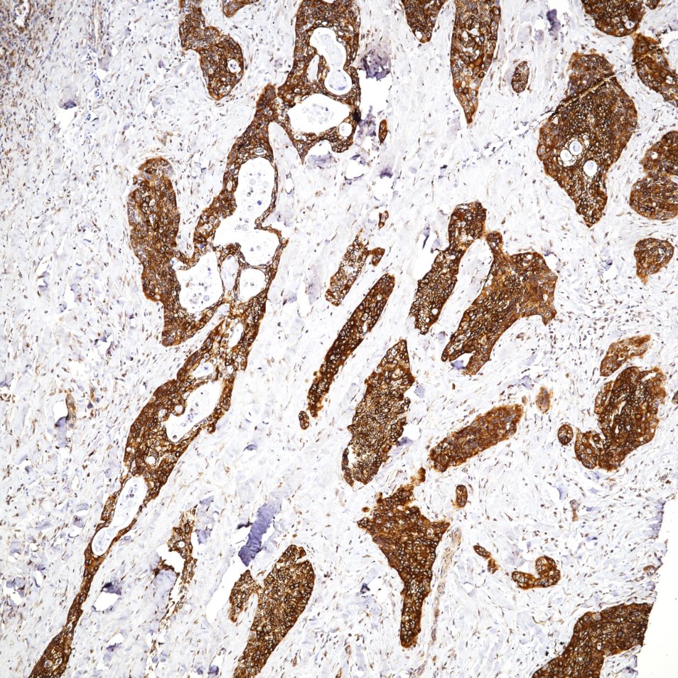 IHC staining of human Lung Cancer using 66828-1-Ig (same clone as 66828-1-PBS)