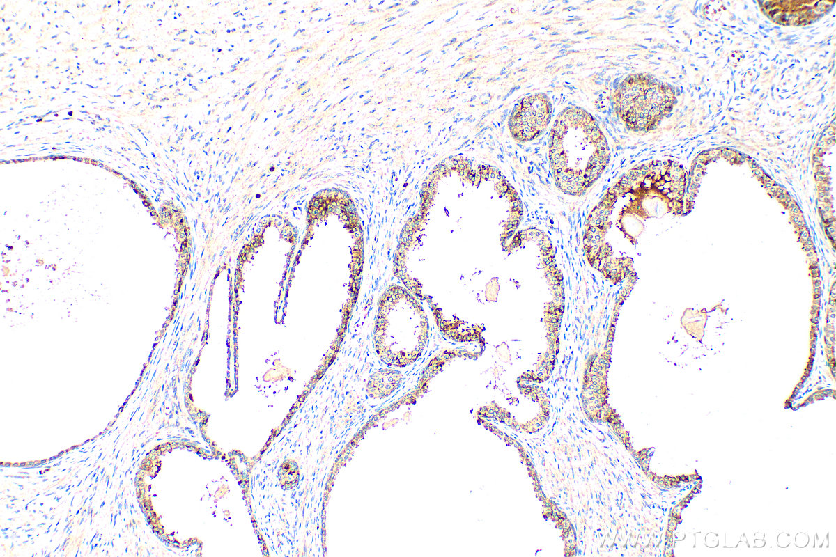 IHC staining of human prostate cancer using 22601-1-AP