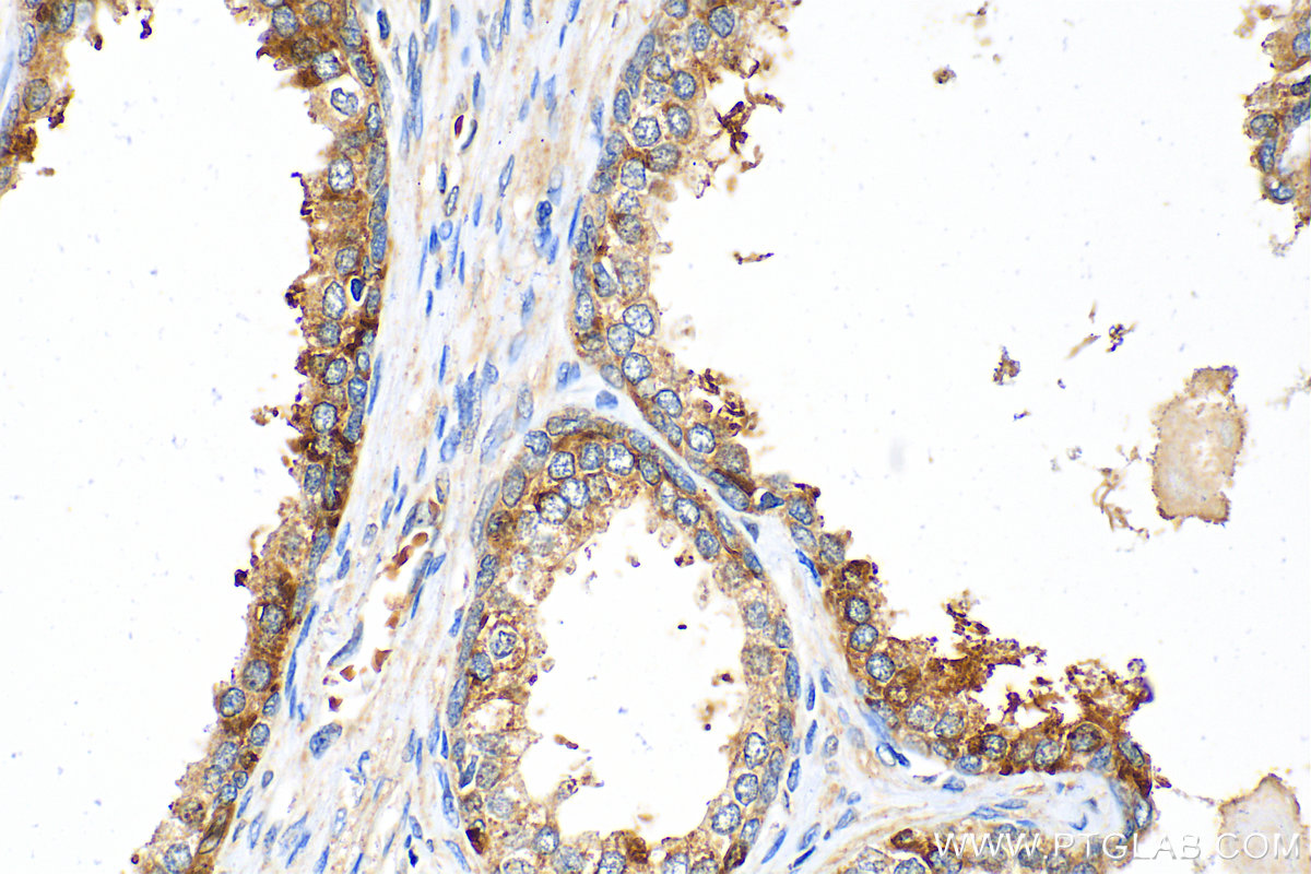 IHC staining of human prostate cancer using 22601-1-AP