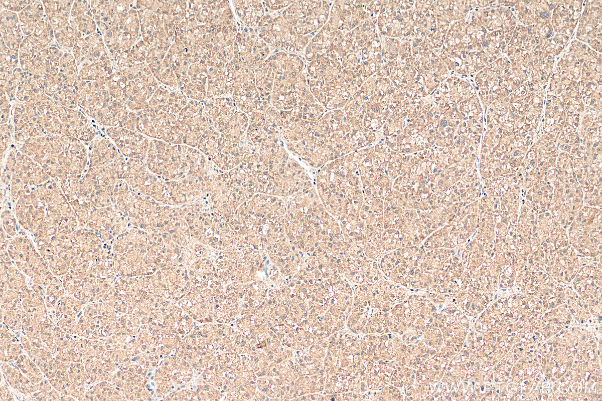 IHC staining of human liver cancer using 24756-1-AP