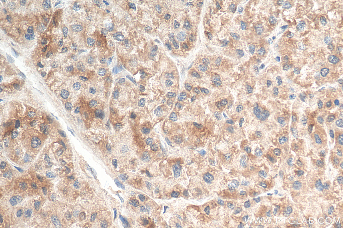 IHC staining of human liver cancer using 24756-1-AP