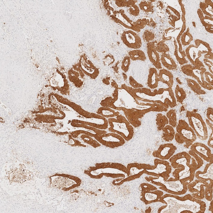 IHC staining of human colorectal cancer using 66096-1-Ig IHC staining of human colorectal cancer using 66096-1-Ig