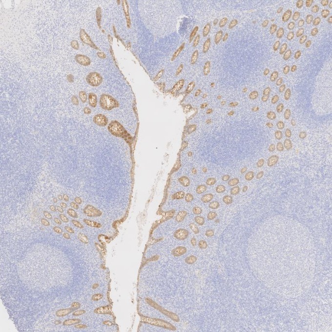 IHC staining of human appendicitis using 66096-1-Ig IHC staining of human appendicitis using 66096-1-Ig