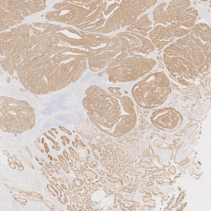 IHC staining of human stomach cancer using 66096-1-Ig IHC staining of human stomach cancer using 66096-1-Ig