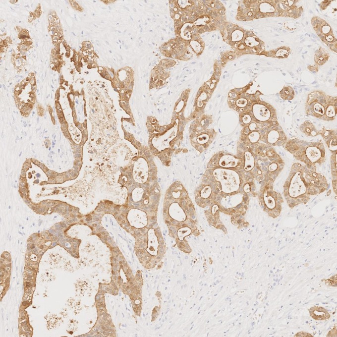 IHC staining of human pancreas cancer using 66096-1-Ig IHC staining of human pancreas cancer using 66096-1-Ig