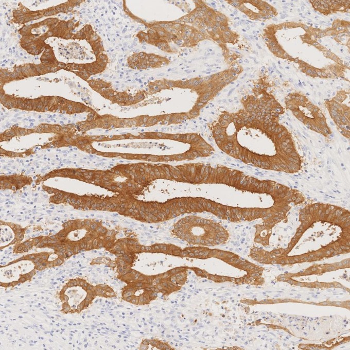 IHC staining of human colorectal cancer using 66096-1-Ig IHC staining of human colorectal cancer using 66096-1-Ig